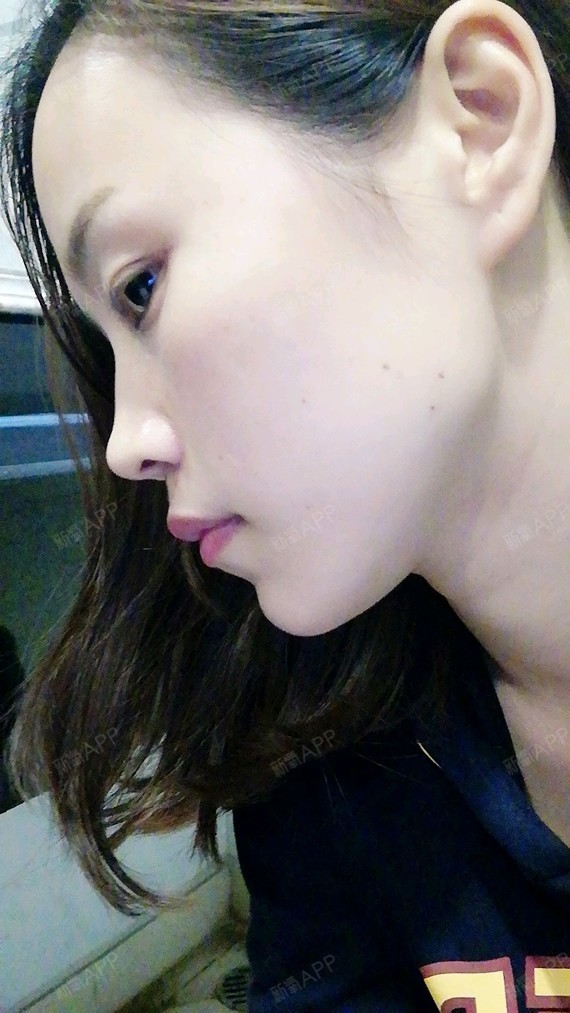 咬肌那里不明显,应该要过段时间