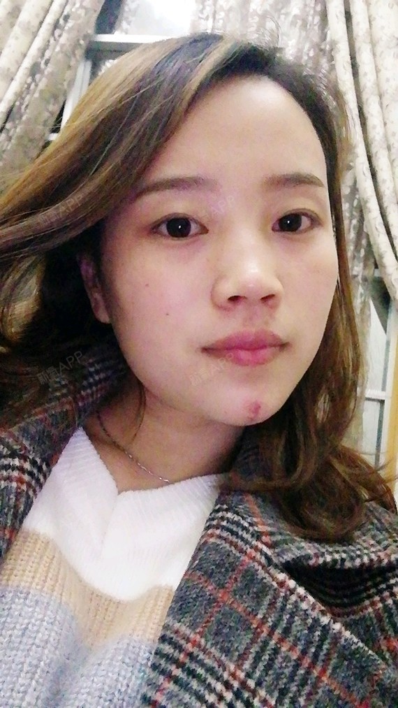 今天瘦脸第六天,真是有效果的,感觉咬肌没那么大了,_圈子-新氧美容