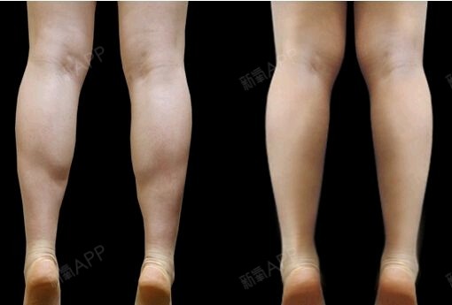 女性的小腿肌肉发达的话,则会导致小腿部位的线条不够完美,腿也会看