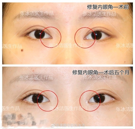 开内眼角矫正内眦赘皮