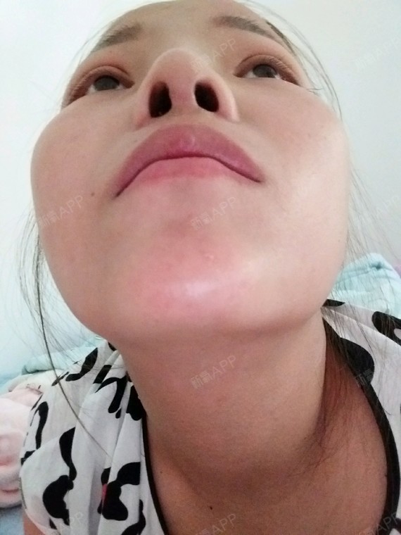 鼻小柱歪了,鼻子是做失败了吗