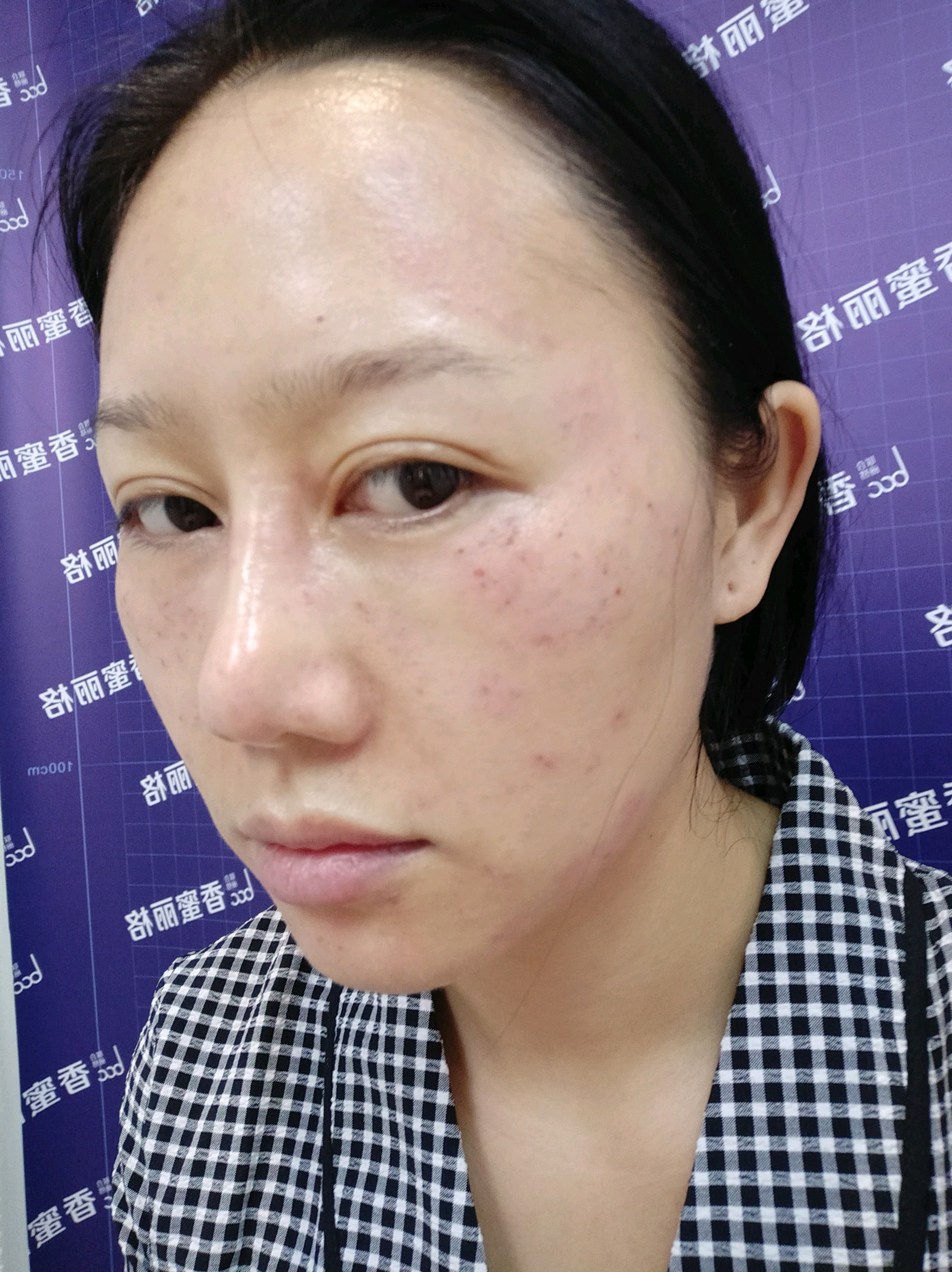 大q皮秒祛斑 美白嫩肤/祛斑/雀斑/黄褐斑/太田痣/晒斑/老年斑秒杀皮秒