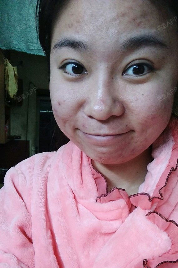 美瞳线掉痂后没颜色很正常,这是因为:美瞳线属于破口上色,结痂是伤口