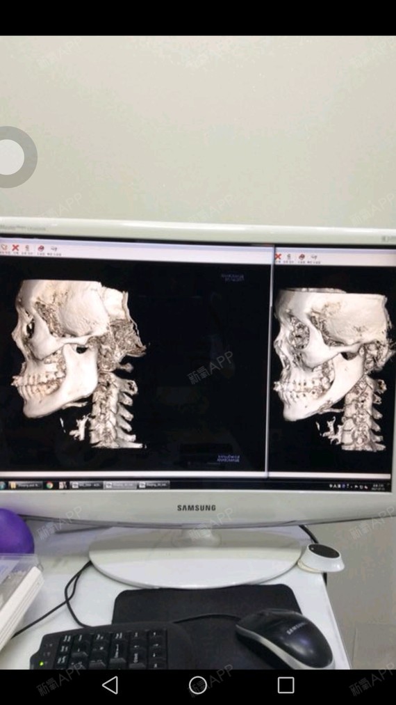 看看我的下颌角ct,华丽丽的一刀弧线