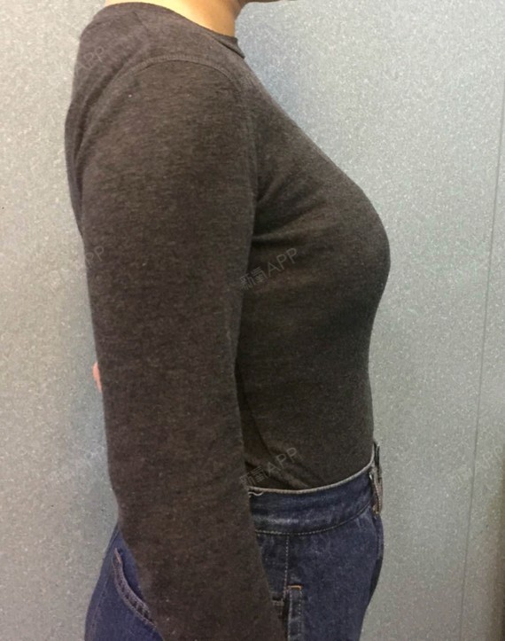 氧气btp9504自体脂肪隆胸第7天美丽日记