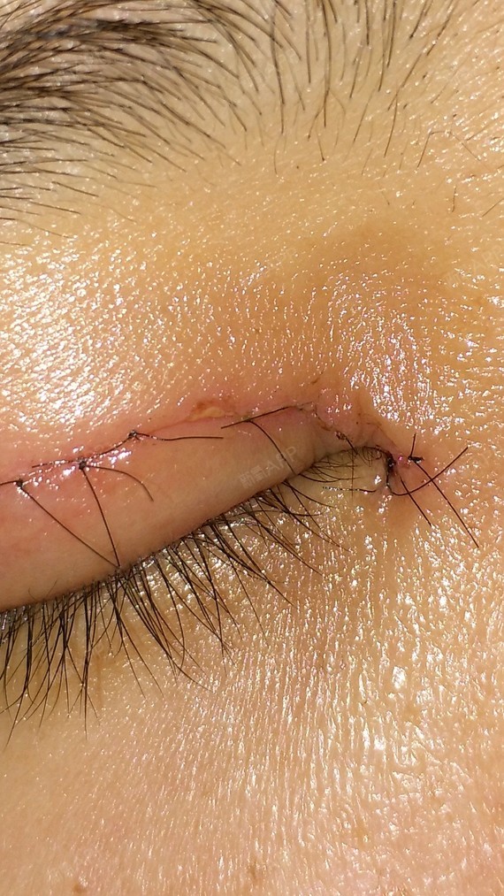 像我这样的人1028831520167564开内眼角第2天美丽日记