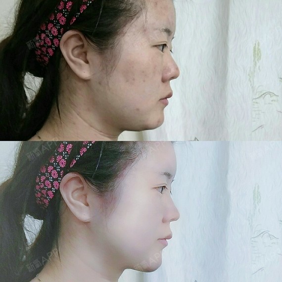 中面部凹陷,丑死了长得像加菲猫从侧面很平,眼睛鼻子_圈子-新氧美容