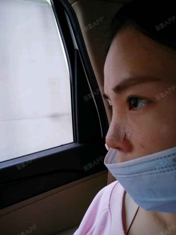 隆鼻假体取出了第七天了