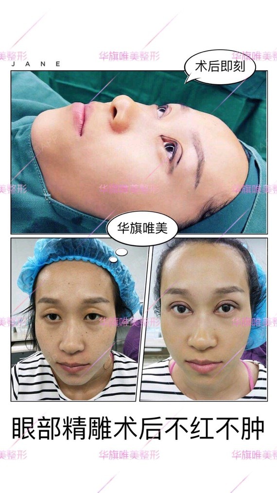 《西北眼王张沙沙》这个美女术前面诊时候,眼窝凹陷,_圈子-新氧美容