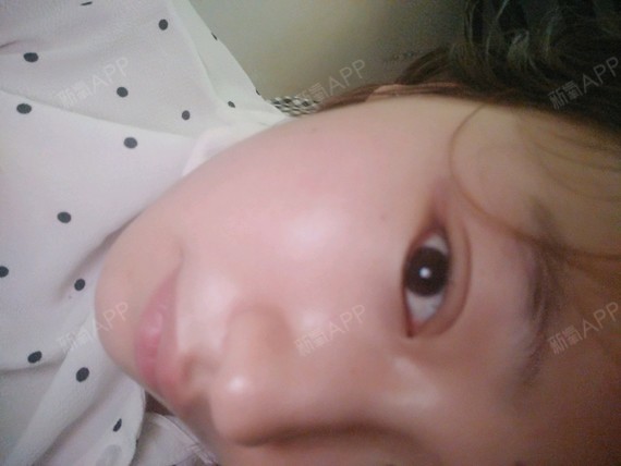 颖宝同款桃花眼戳这里~_圈子-新氧美容整形