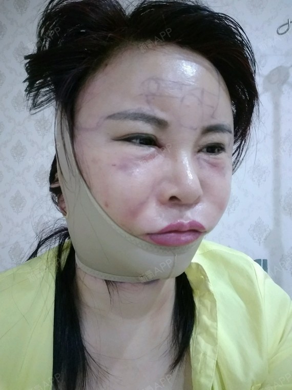 忘了给美女护士说吃止疼药,麻醉药过后,整个面部肿胀_圈子-新氧美容