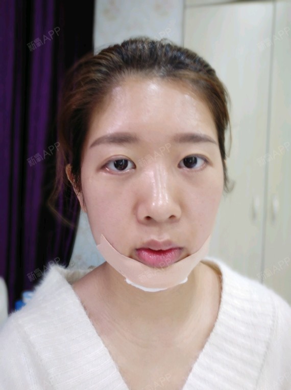 韩式生科硅胶垫下巴第一天