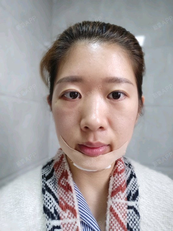 【韩式生科硅胶垫下巴 第一天】