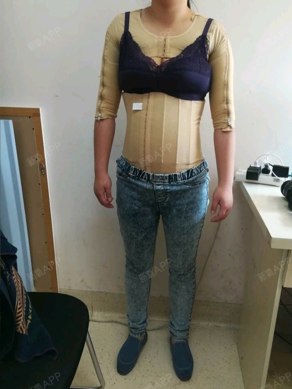 新氧- 小幽幽 | 美体塑形 | 吸脂瘦手臂 | 吸脂瘦腰部 | 吸脂瘦腹部