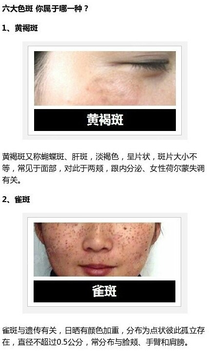 看图识斑系列,其实很多人脸上的斑不只是一种,要想准_圈子-新氧美容