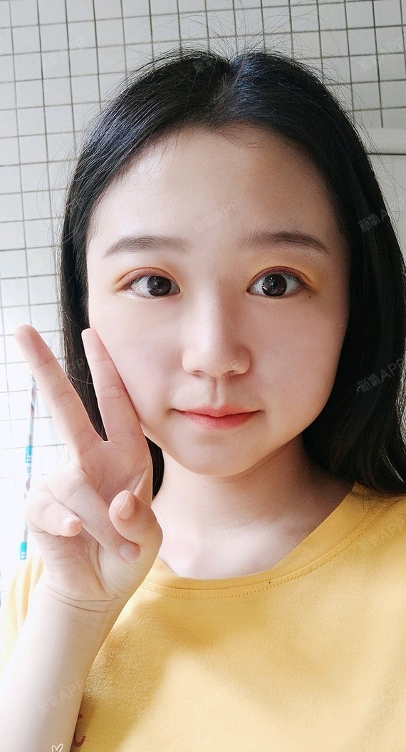 定点双眼皮
