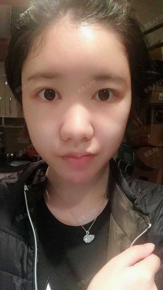 自体脂肪填充额头