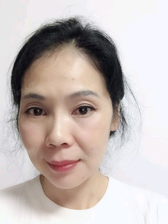 【提眉 去眼袋术后第151天】怀着激动地心情写日记_圈子-新氧美容整形