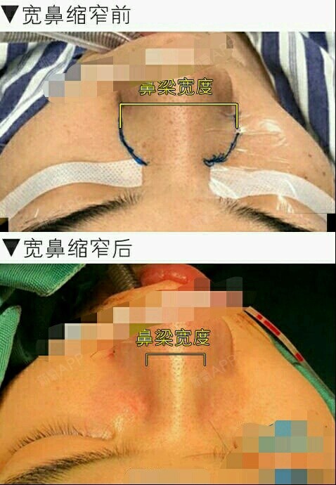 鼻骨太宽,鼻子会像"趴"在脸上一样不立体.