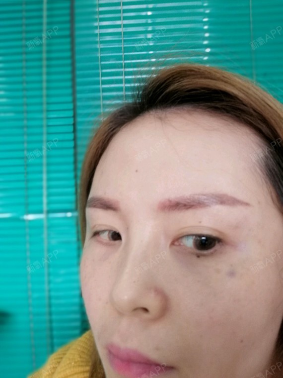 注射除皱第一天,针眼处还有非常明显的淤青!