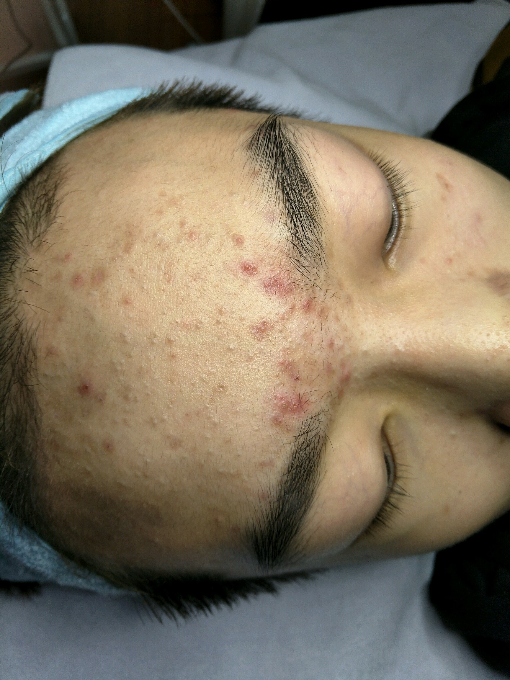 这是我第一次做针清痘痘,讲真还是有点痛,可能我不耐_圈子-新氧美容