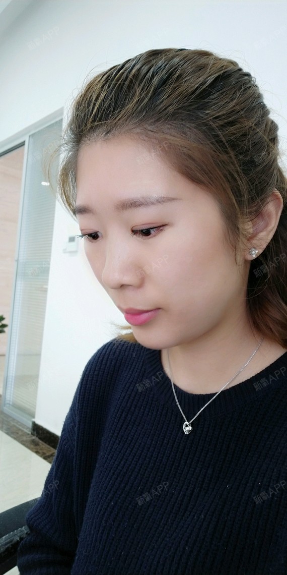 韩式生科下巴第20天