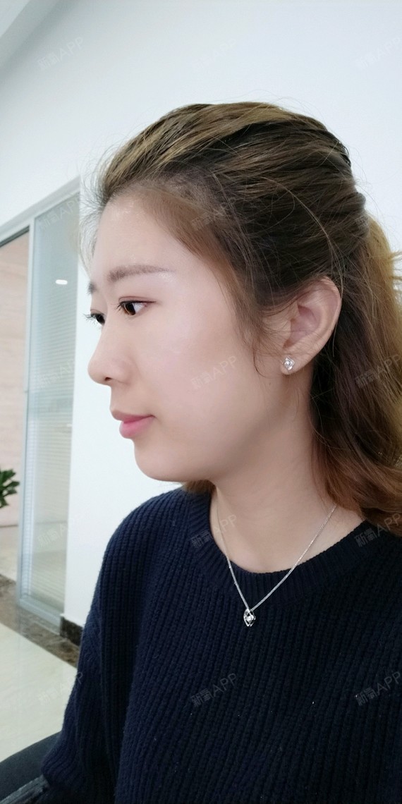 韩式生科下巴第20天