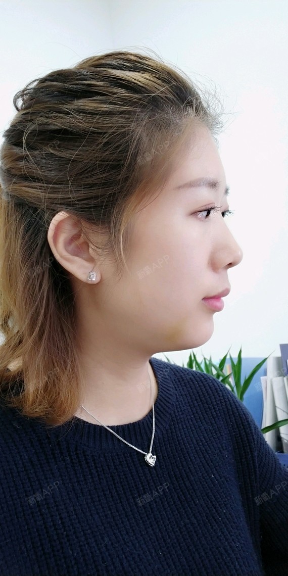 韩式生科下巴第20天