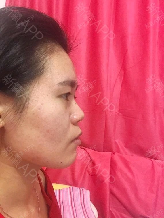 面中部凹陷,整个鼻子都凹中在脸上!不单单是鼻基地,还需要什么!