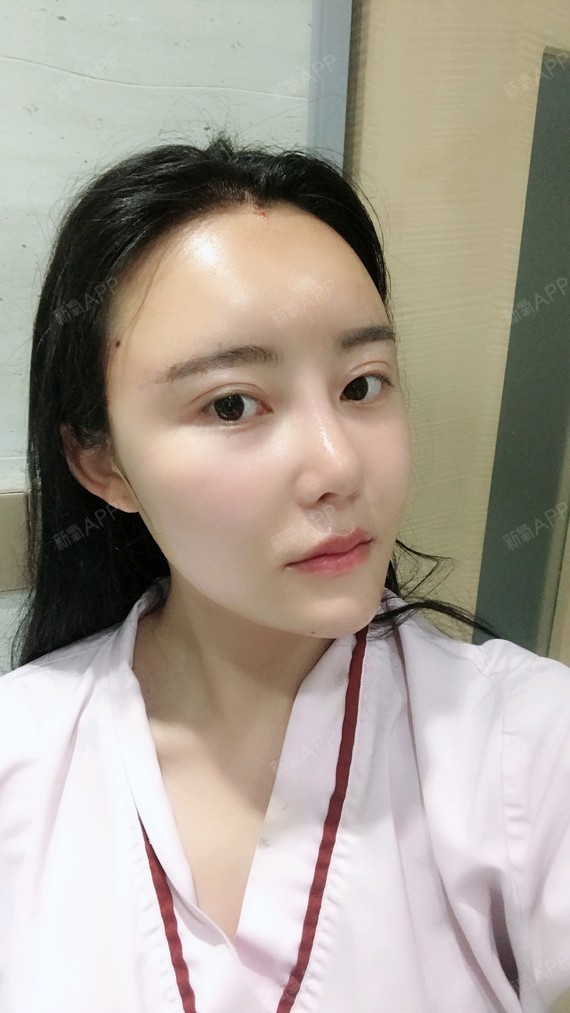 【重庆美仑美奂自体脂肪填充】
