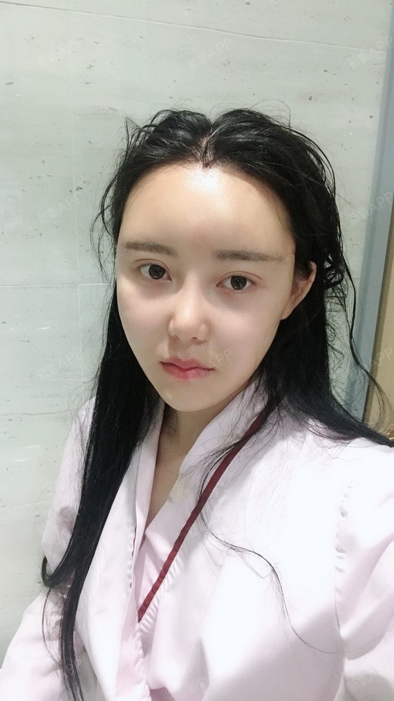 【重庆美仑美奂自体脂肪填充】