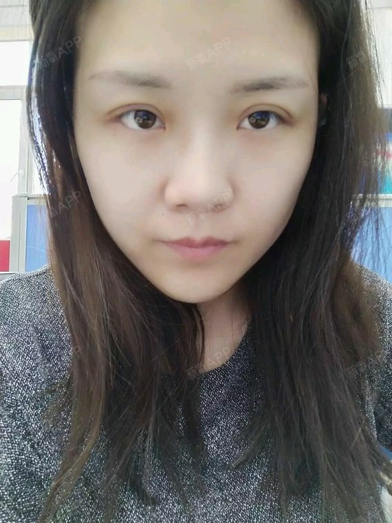埋线双眼皮