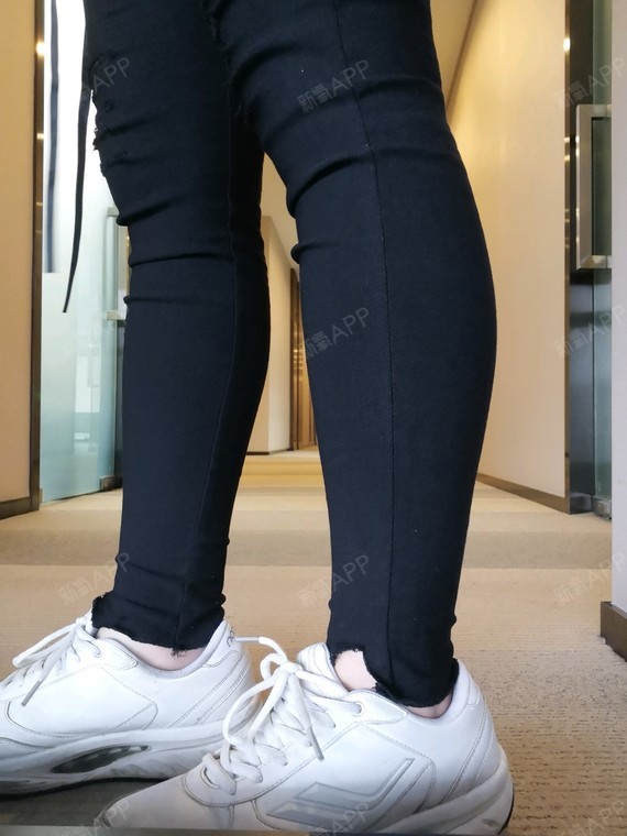 成都注射瘦小腿好不好_效果图_氧气nac3bbc注射瘦小腿术后第43天_新氧