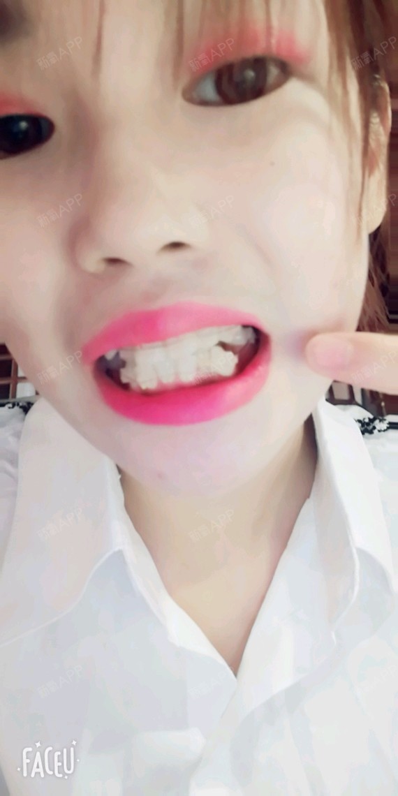 乘着周末再来更新一下日记吧,目前牙套没有出现什么异_圈子-新氧美容