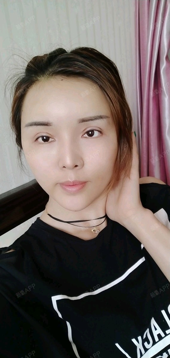 这个是第十天的照片,双眼皮自体脂肪都给大家看看效果_圈子-新氧美容