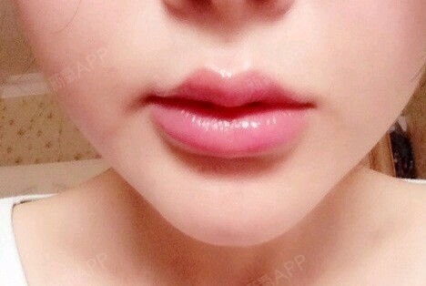 【成都花田】唇珠美容术上唇唇红中部结节状突出称为唇_圈子-新氧美容