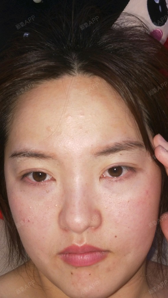 眼睑下至内切无疤,打造无辜大眼肇庆华美医学美容医院_圈子-新氧美容