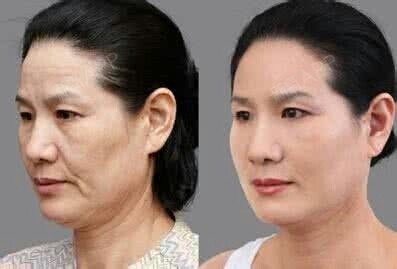 全颜面除皱女人到了一定的年龄阶段,不论如何