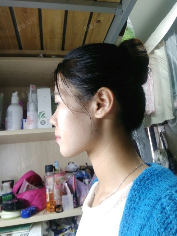 有时候觉得还正常,有时候简直丑的一_圈子-新氧美容整形