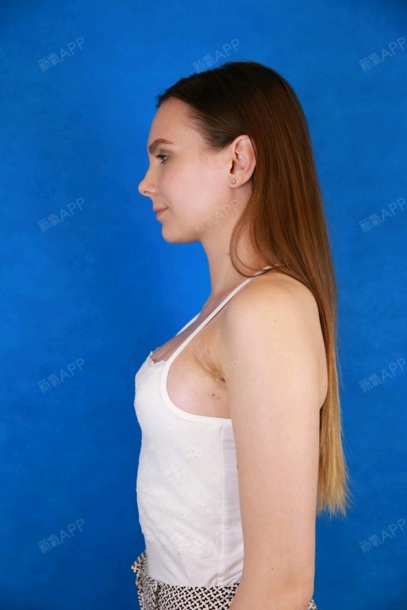 【假体丰胸】今天是术后12天了,第7天去医院拆的线_圈子-新氧美容整形