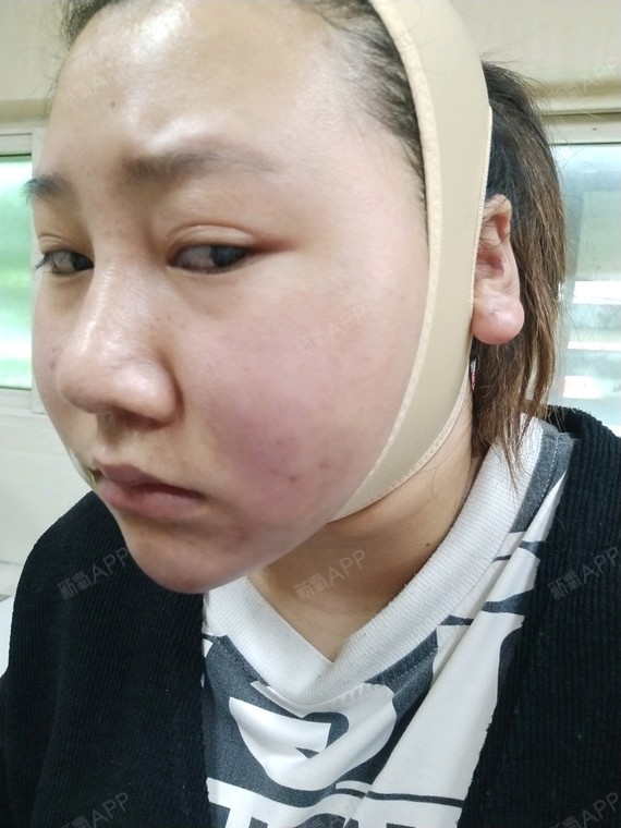 做完吸脂第三天脸红红的双下巴和伤口还疼是_圈子-新氧美容整形