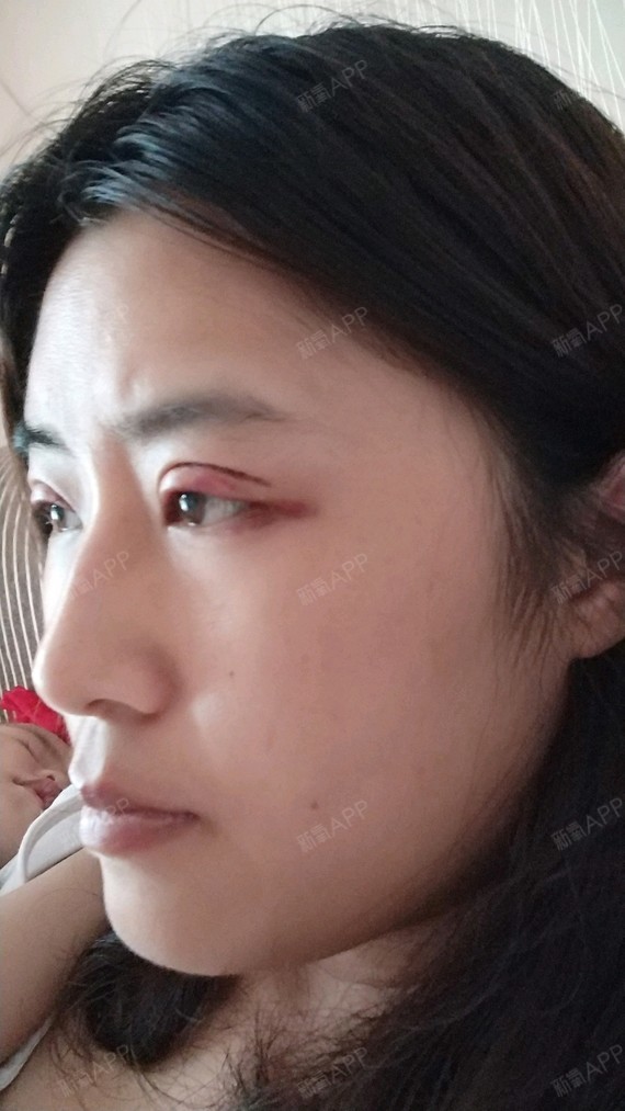夜里睡得枕头低了点早上起床眼睛有点肿
