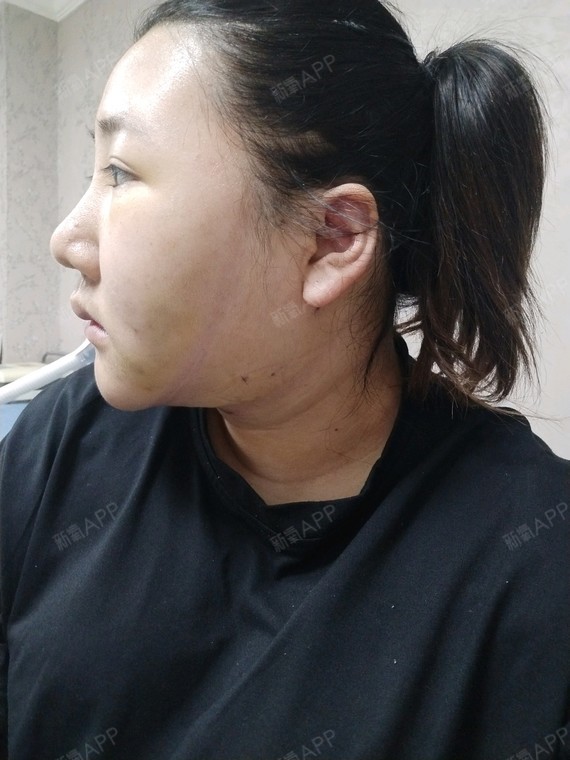 面部吸脂,下颚缘,双下巴吸脂第7天,今天去拆线了,_圈子-新氧美容整形
