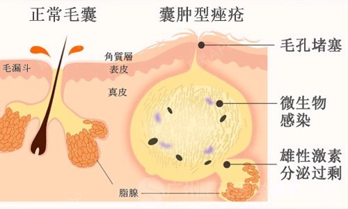 對痤瘡發展起重要作用的關鍵致病因素是皮脂腺分泌亢進,毛囊口角化