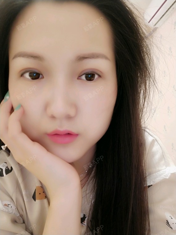 我又来啦,分享一下我纳米无痕全切双眼皮快一个月啦,_圈子-新氧美容