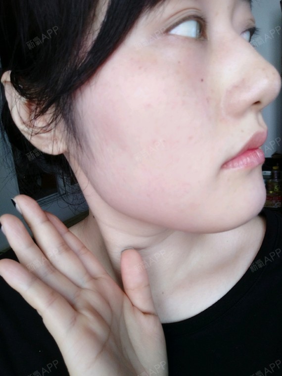 瘦脸 | 肉毒素瘦脸 | 微整形 | 术后当自强 | 上海同城 | 溶脂针