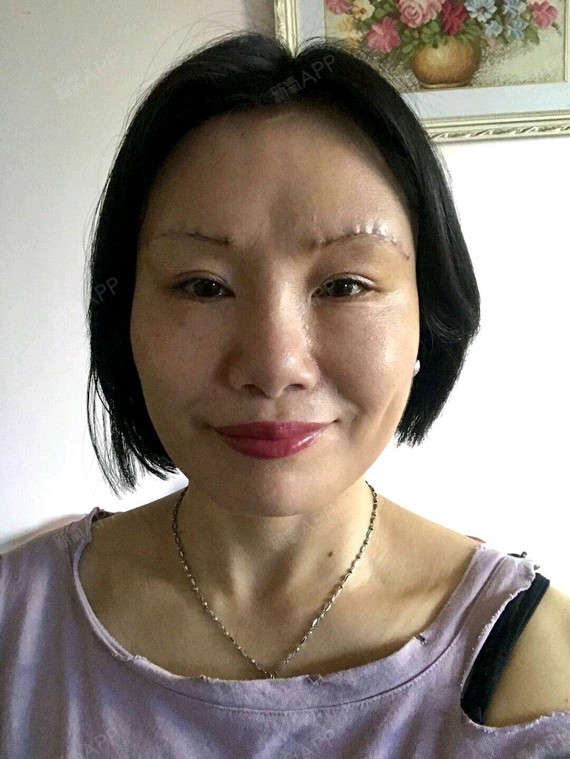 切眉术好不好_效果图_小德玛西亚切眉术术后第5天_新氧美容整形