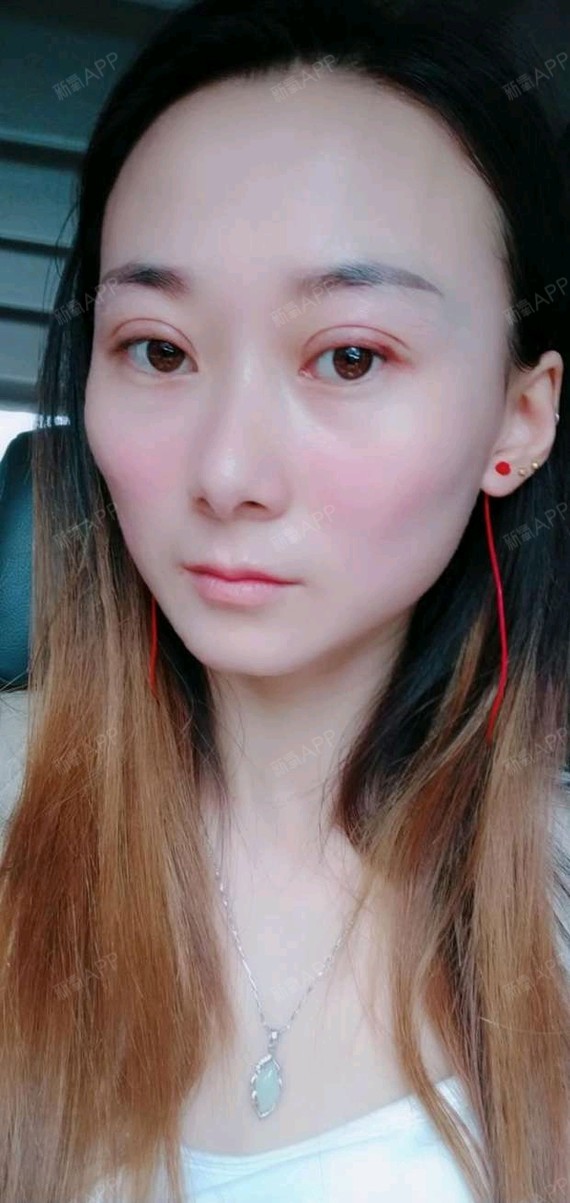 氧气qvca135切开双眼皮第11天美丽日记