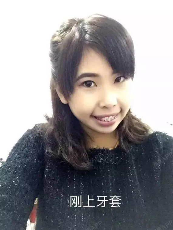 摘牙套啦,嘴巴再也没有往外翻了,以前像香肠嘴一样, 难看死了,现在不