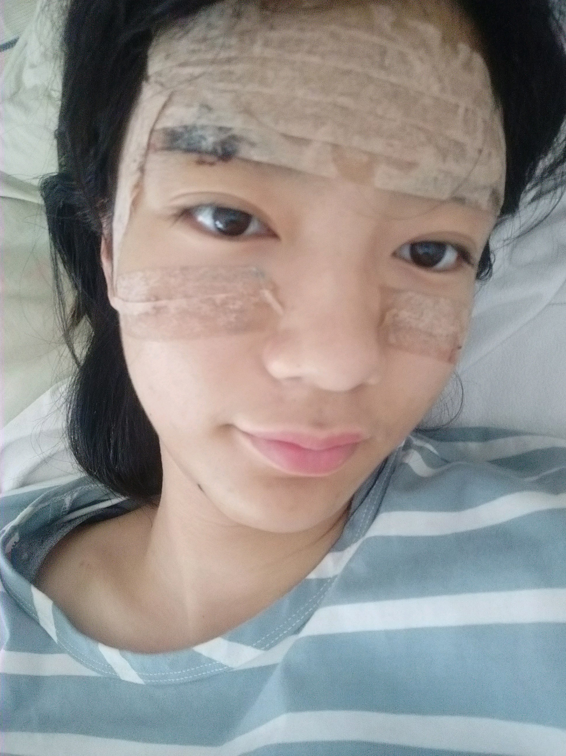 郑州元素美学整形自体脂肪全脸填充怎么样_恢复过程_效果如何_cherry